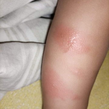 Rashes ni little one