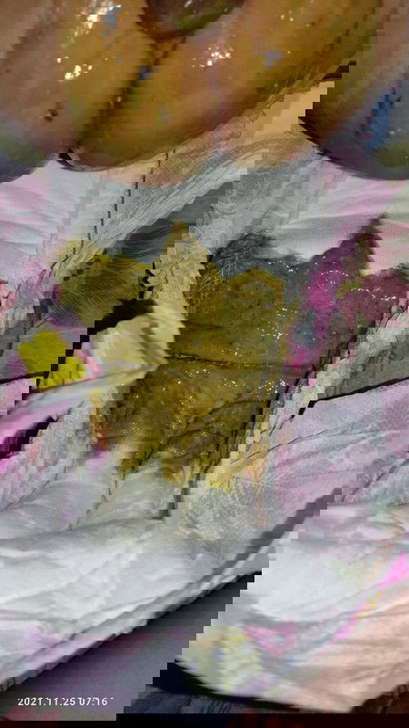 Diarrhea ( amoebiasis, rotavirus,cows milk protein allergy, or lactose intolerance?)