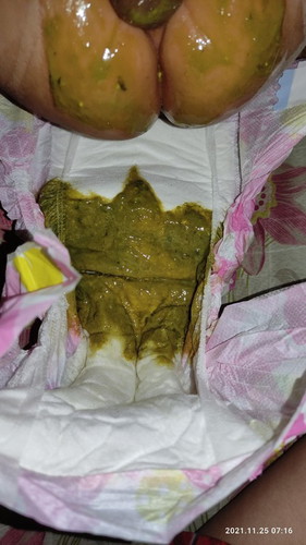 Diarrhea ( amoebiasis, rotavirus,cows milk protein allergy, or lactose intolerance?)