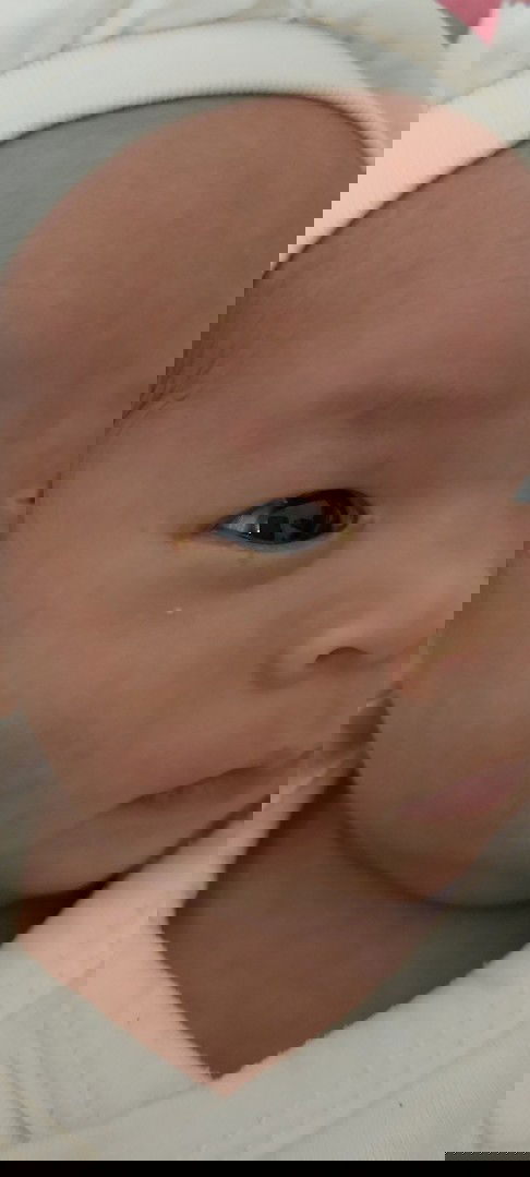 Bé 20 ngày tuổi bị ghèn mắt