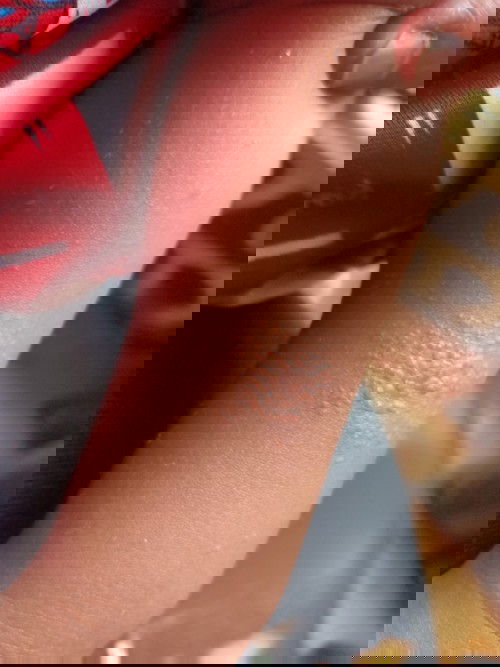 bintik" di kulit bayi