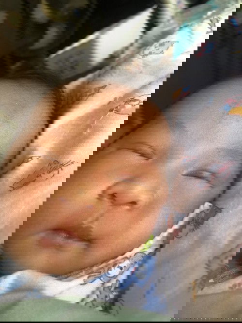 ตาแฉะมีขี้ตา  ทารก 15 วัน