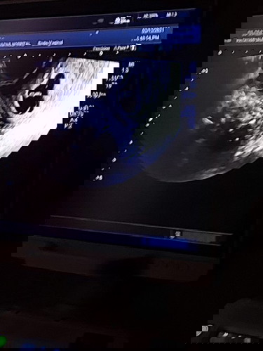 ท้องแรก ท้องได้ 2 เดือนกว่าๆแล้วมีเลือดออกได้ 3 วัน วันนี้ไปหาหมอ หมอซาวเจอเด็กแต่หัวใจน้องไม่เต้น