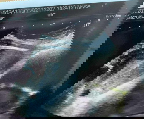 hamil kosong / luar rahim