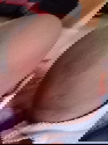 Merah dikulit kepala bayi