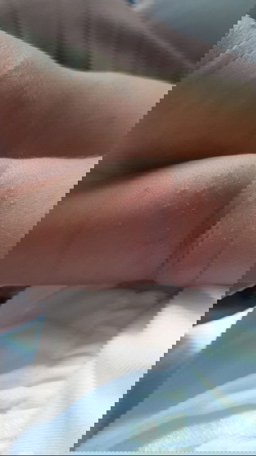 Tangan bayi muncul bintik merah menonjol