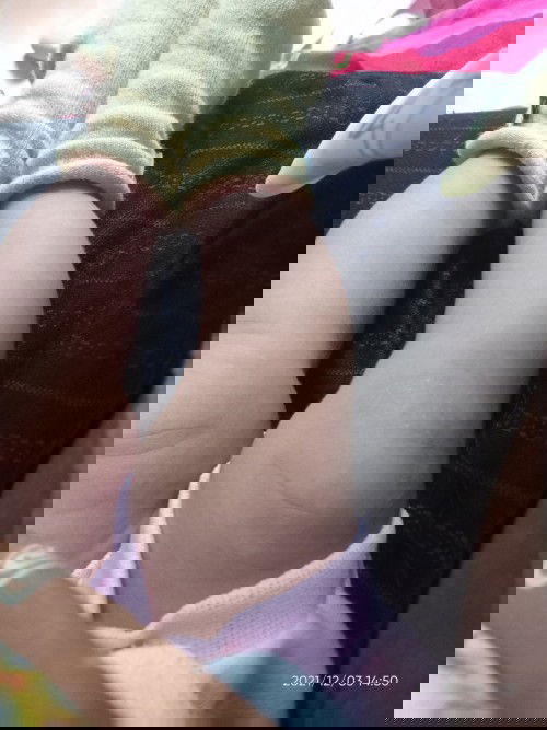 Kaki anak agak bengkok