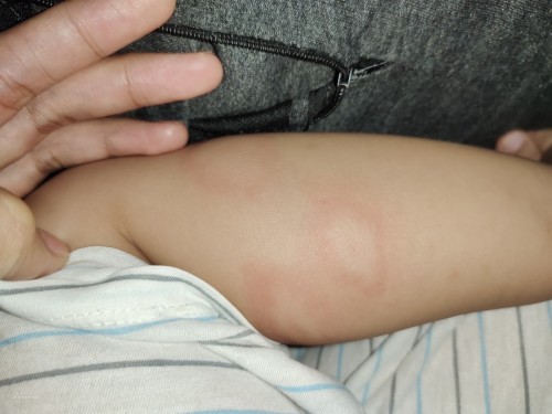 Insect bite