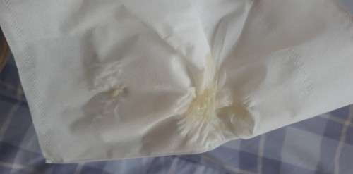 สอบถามค่ะมีมูกไหลเเต่ไม่มีเลือดออก