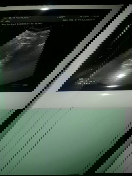 Hasil usg dan hpht beda