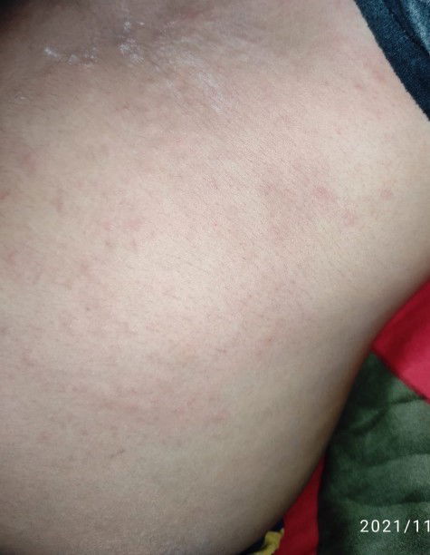 Gatal hingga ruam dan panas