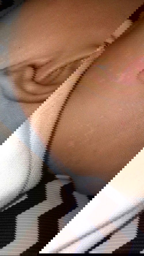 Bintik putih pada kulit bayi