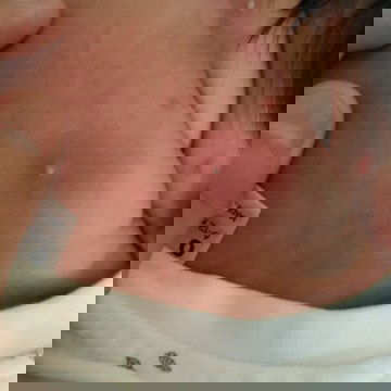 Ano po kaya to.isa lang yan nung una tapos nung pumotok biglang dumami. Parang may nana sya.