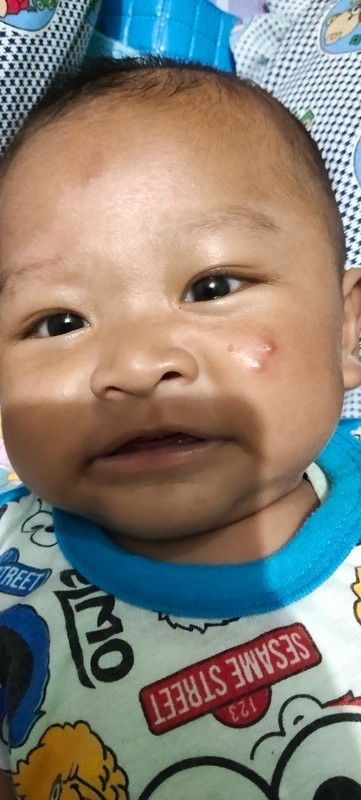 Jerawat bayi