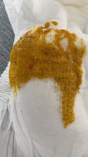 Why breastfeed 2 months plus old baby poo have abit of blood ? Please help!