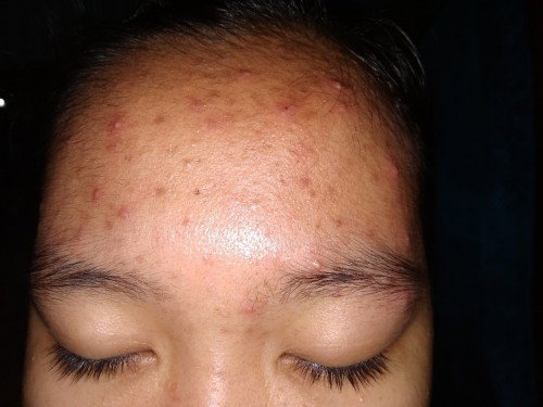 Cara menghilangkan jerawat
