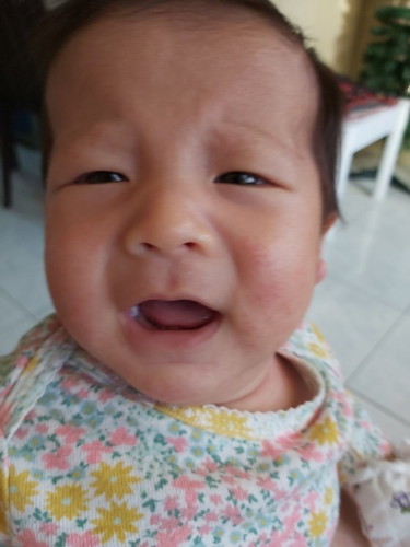 Baby face rash