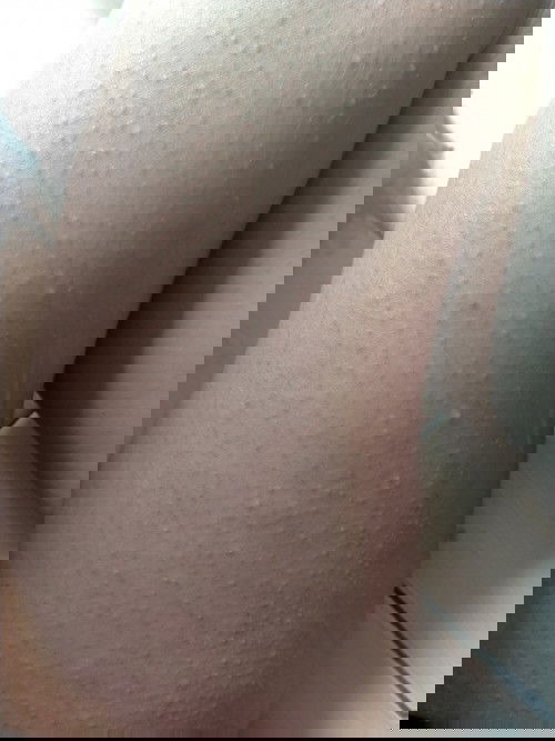 Gatal dan berbintik kecil"Saat hamil 🤰🏻