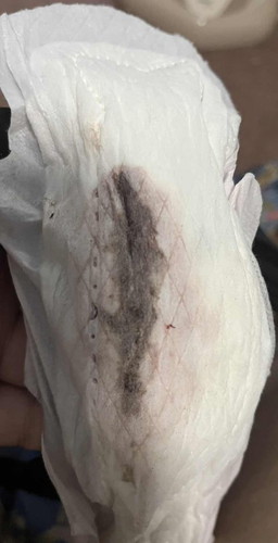 ท้องได้ 4w ตามอัลตร้าซาว มีเลือดออกสีน้ำตาล วันนี้วันที่ 4 ออกเยอะจนตกใจ..น้องจะรอดมั้ย?_สรุปน้องไม่รอดนะค่ะ น้องฝ่อไปแล้ว ไม่เจริญเติบโต แท้งค่ะ