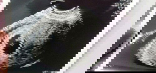 Assalamualaikum dokter di rahim saya ada luka dokter apa obat terbaik untuk luka di rahim saya dok?