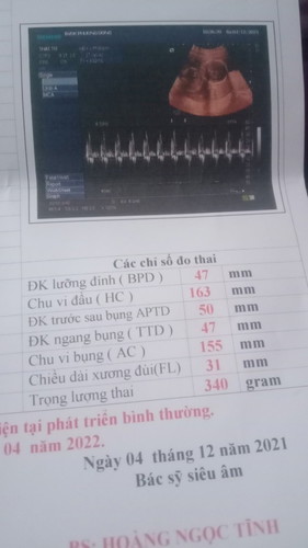 Em bầu được 20t mà bé đc 340gm có bé quá không mọi người