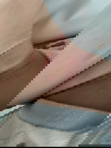 Is this heat rash?