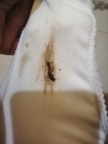 Brown discharge