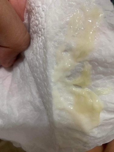 IF MUCUS PLUG ?