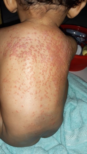 Obat gatal pada anak