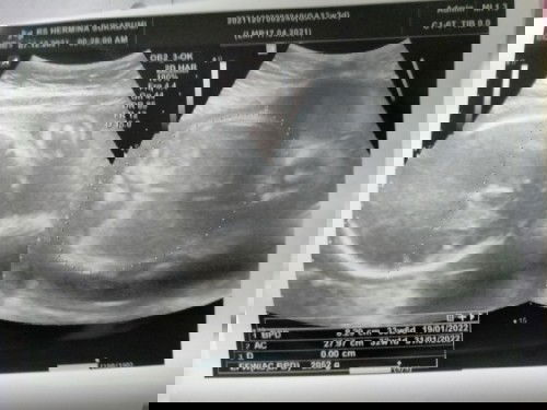 Hpl maju dan ada lilitan tali pusat