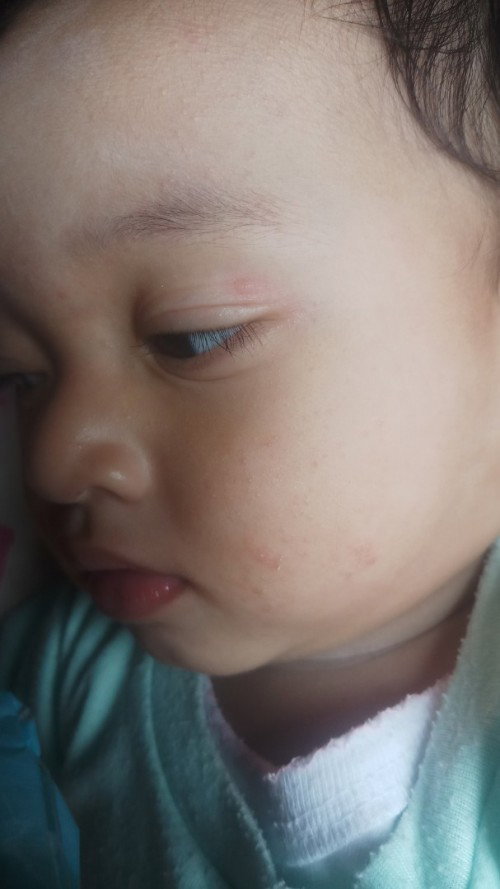 bintik pada muka
