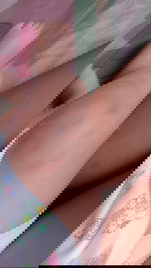 Alergi atau digigit nyamuk