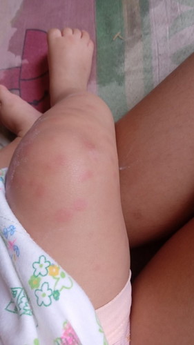 Alergi atau digigit nyamuk