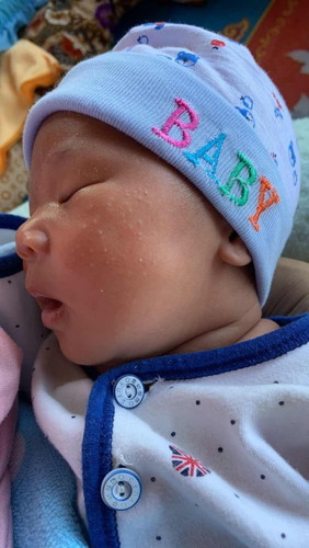 หน้าเป็นผื่นขึ้นบริเวณใบหน้า