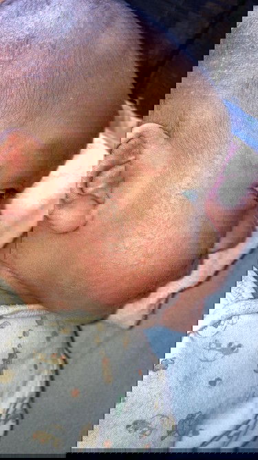 น้องมีผื่นขึ้นตรงแก้ม