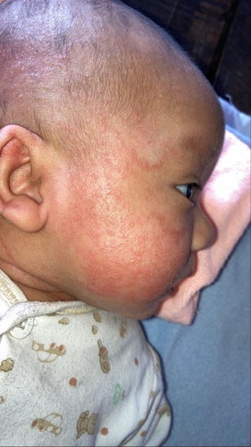 น้องมีผื่นขึ้นตรงแก้ม