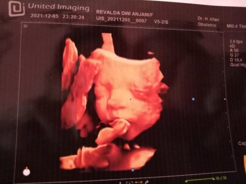 hasil usg anak pertama kehamilan 25-26 week