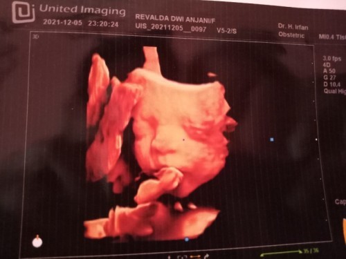 hasil usg anak pertama kehamilan 25-26 week
