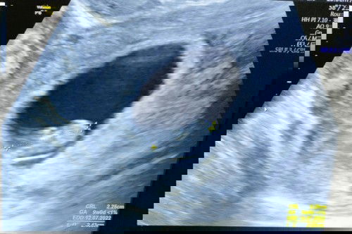 Djj belum terdeteksi di 9w ukuran janin