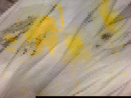 Diare atau masuk angin