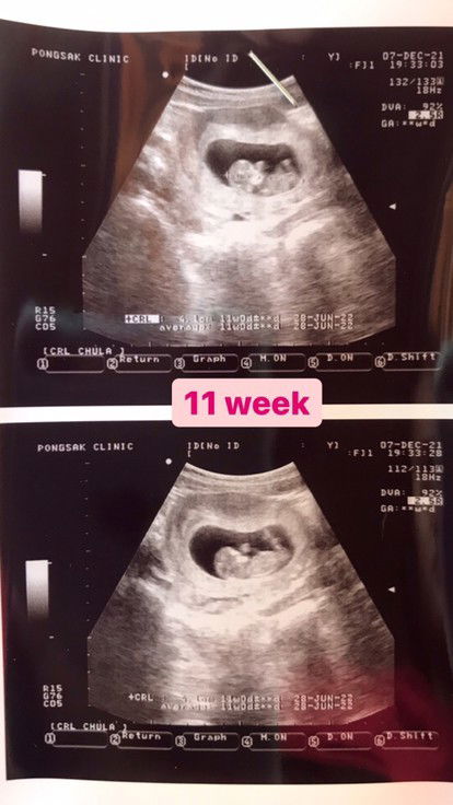 อยากสอบถามคนที่ดูใบซาวด์เป็นจ้า ว่าน้องสมบูรณ์ไหมค่ะ