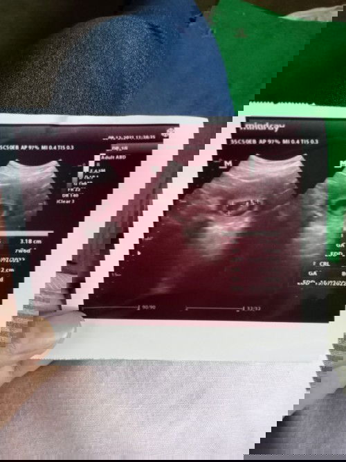 Nanya tentang usg 2D