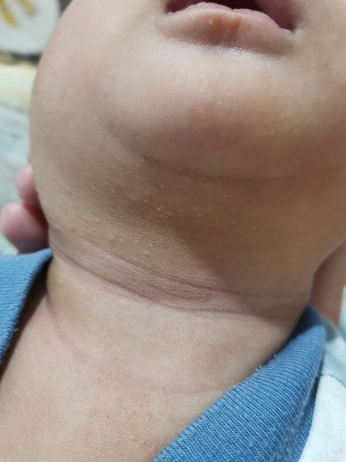 Bintik pada muka dan leher