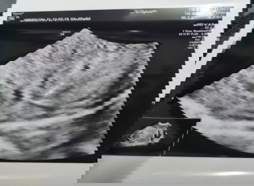 5w6dไม่เจอถุงตั้งครรภ์ จะเสี่ยงท้องนอกมดลูกไหมคะ