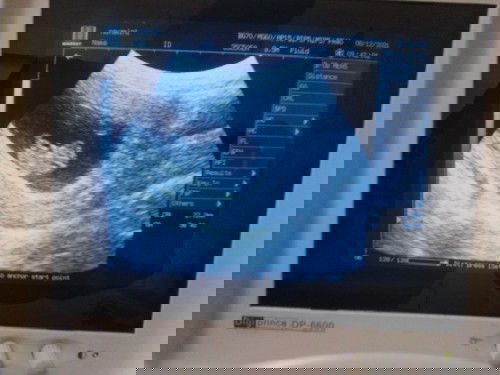 อัลต้าซาวด์ไม่ตรงกับในสมุดสีชมพู