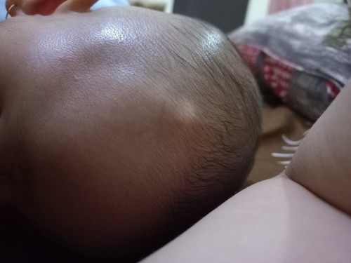 Benjol keras di kepala bayi