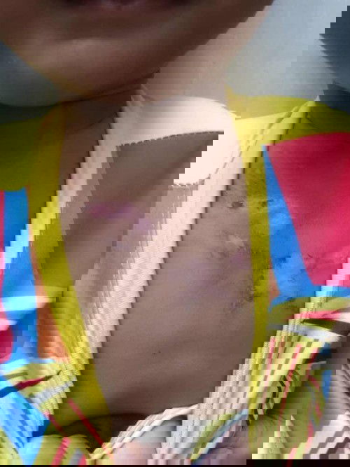 สอบถามคะ แผลน้ำร้อนลวก