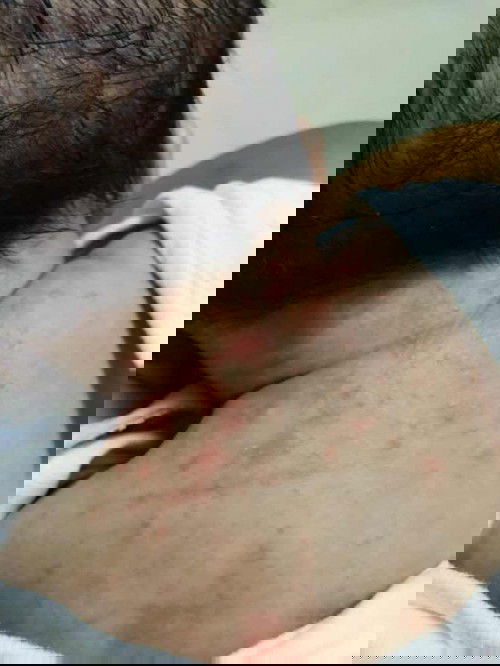 baby acne po ba ito ano pong pwedeng gawin po 1 month old si baby