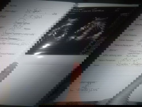 USG tapi baby nya belum mau nunjukin wajah nya