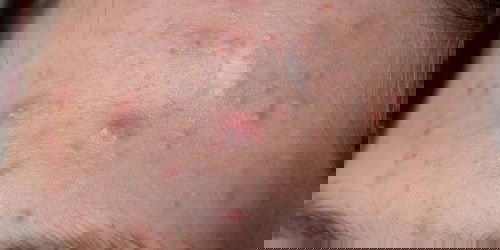 Apakah benar jika hamil muda 4 minggu muncul jerawat batu (namun perlahan mengempes) apakah anak kita laki-laki?